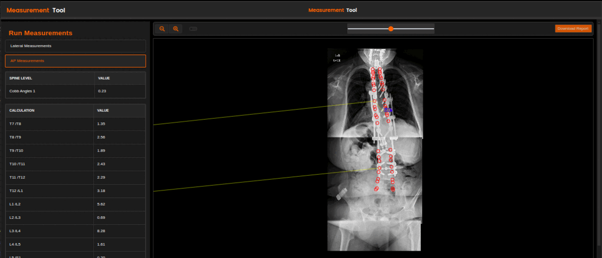 Spine Surgical Planning A