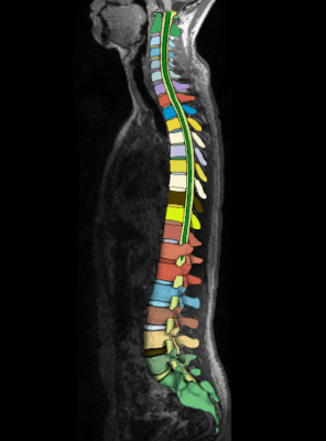 Spine Surgical Planning A